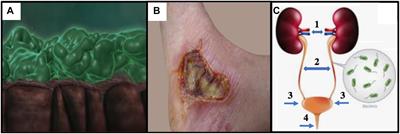 The Bactericidal Tandem Drug, AB569: How to Eradicate Antibiotic-Resistant Biofilm Pseudomonas aeruginosa in Multiple Disease Settings Including Cystic Fibrosis, Burns/Wounds and Urinary Tract Infections